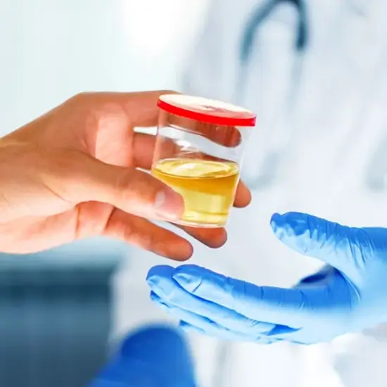 microalbumin, 1st morning random urine test